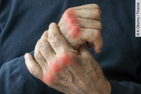 Hände eines älteren Menschen mit Arthrose. 