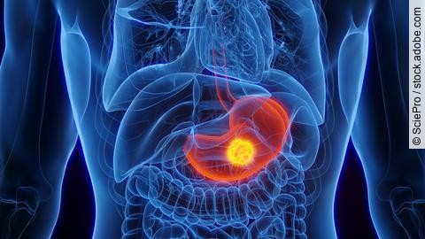 3D-Illustration der inneren Organe eines Mannes mit Magenkrebs, wobei der Magen farblich hervorgehoben ist.