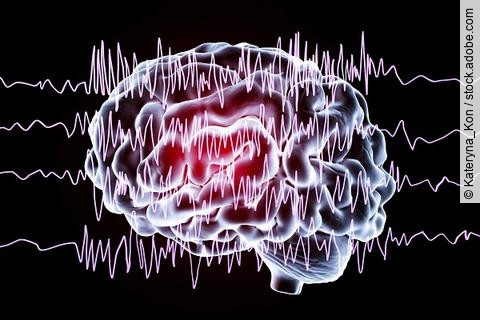 Gehirn und Enzephalogramm während eines Krampfanfalls; Symbolbild Epilepsie